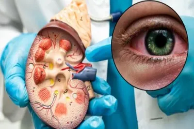 કિડની ફેલ્યોર પહેલા આંખોમાં દેખાય છે રોગના લક્ષણો