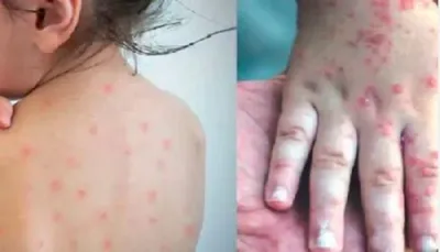 ડીસા તાલુકામાં વાયરલ ફીવર અને ઓરીના કેસમાં થયો વધારો  આરોગ્ય વિભાગ સતર્ક